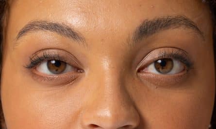 corriger les paupières tombantes