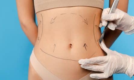 l’abdominoplastie