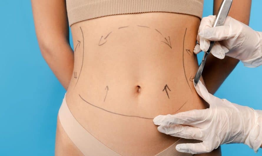 Tout savoir sur l’abdominoplastie pour retrouver un ventre plat